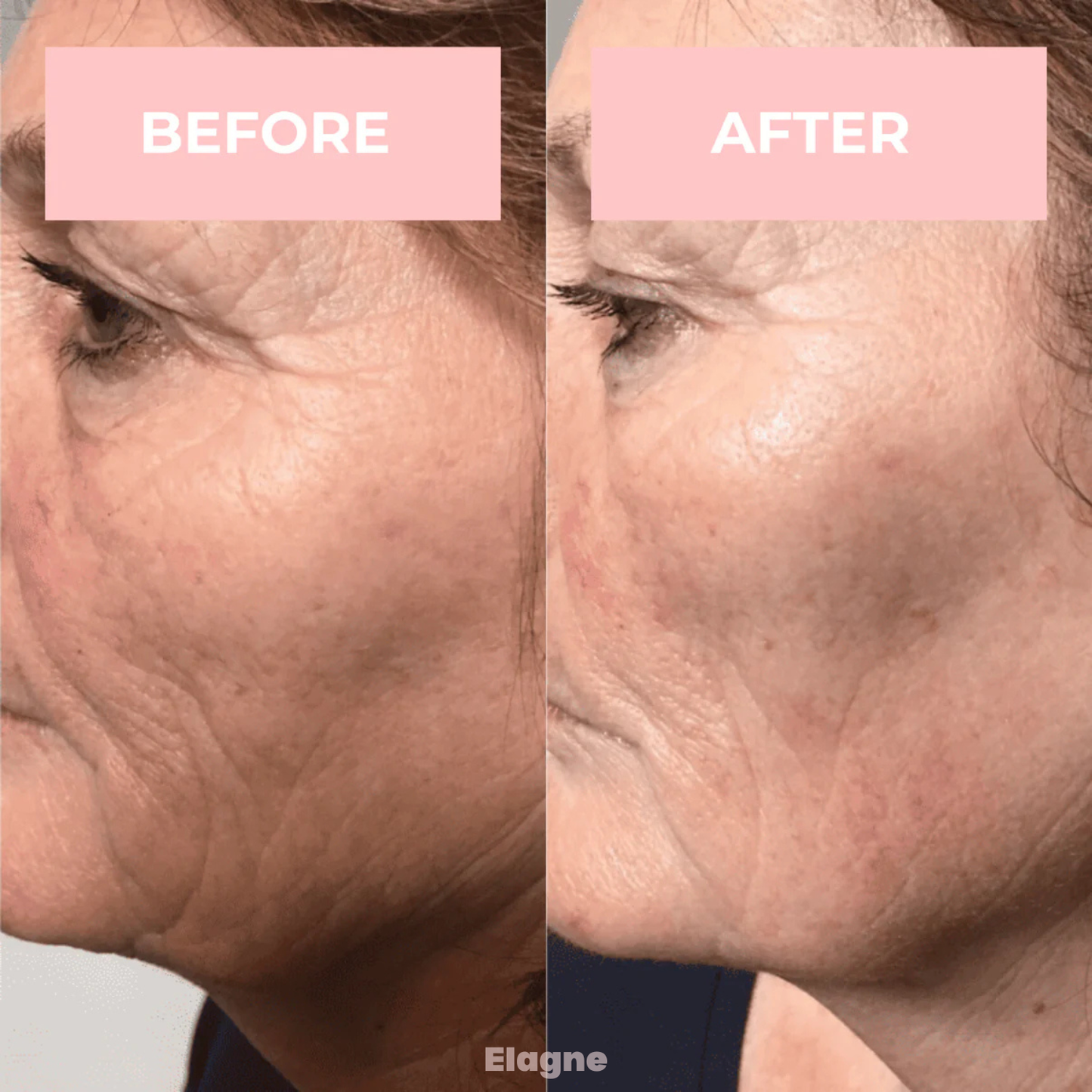 YouthBeam® High Frequency Facial Wand